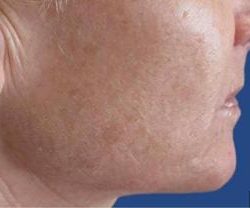 Secret RF Before & After Patient #1618